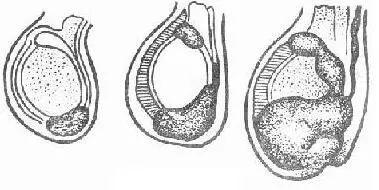 睾丸鞘膜积液对男性不育的影响