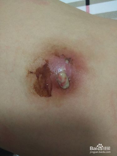 儿童背部疖子治疗全纪录