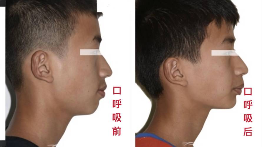 孩子口呼吸会变丑,需尽早干预?这些事千万别