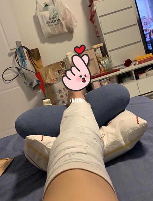 髌骨骨折拆石膏啦_医疗健康_医疗健康其他