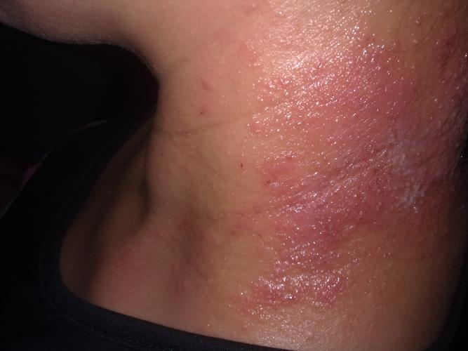 脖子这有红色的一块