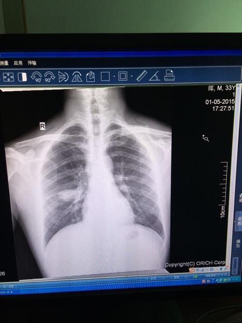 论坛各位便宜帮忙看我家人胸片是不是肿瘤?