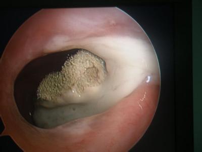 慢性上颌窦炎的护理措施有哪些 慢性上颌窦炎是什么引起的