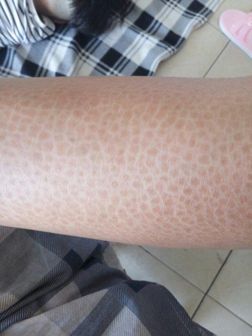 这皮肤是蛇皮病吗?