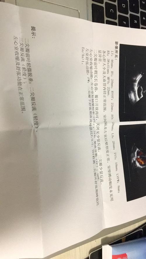 二尖瓣前叶轻微脱垂,二三尖瓣关闭时见少量反流(轻度)