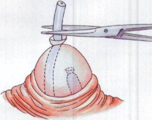 我生完孩子后不想做结扎手术,不知去计划生育站放环行
