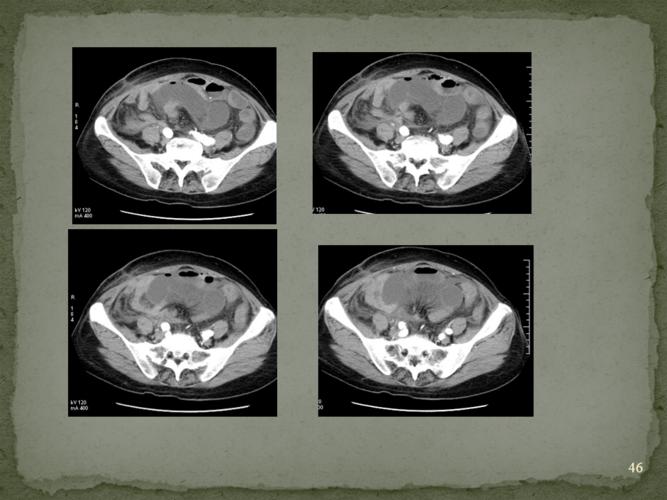 ct入门 | 肠梗阻的ct影像诊断