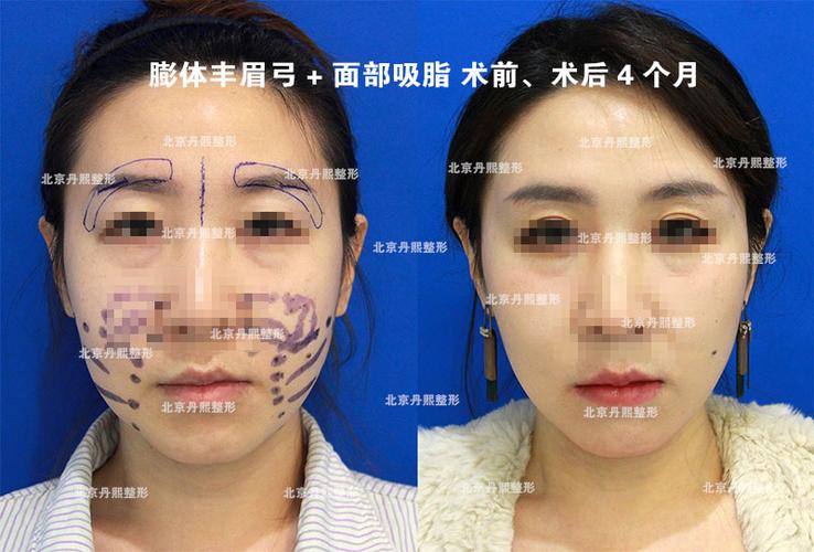 假体丰眉弓联合下面部吸脂塑形案例