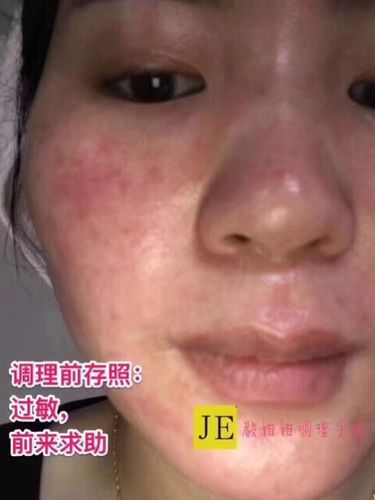 导致的了激素脸,三天两头过敏,实在不堪忍受,前来求助…一个月的调理