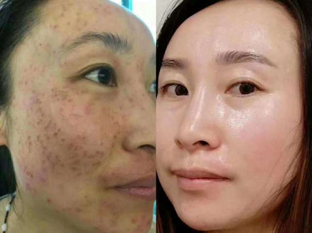 黄褐斑救星:中医治疗黄褐斑,1月退斑,治愈率高达96%