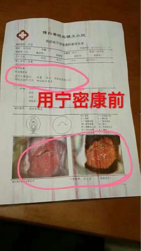 [宫颈糜烂,纳氏囊肿,肥大案例]