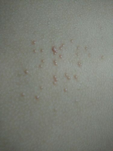 儿子13岁,后背上今天发现长了好多肉色类似泡泡的小疙瘩,大大