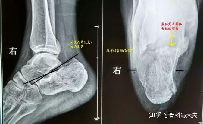 第二张图标示的是一个正常的跟骨的一些解剖状态,它有一个正常的贝累