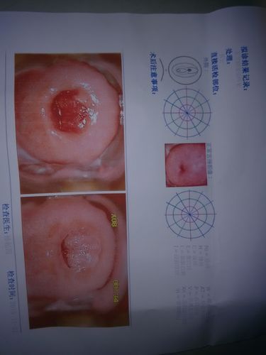 嗯,我去做了一个 筛查,医生说接触性出血,给我开了妇炎平栓