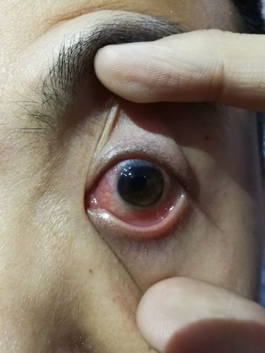 眼睛布满血丝,黑眼球上下边缘模糊,有点儿像化脓的样子,疲劳的时候有
