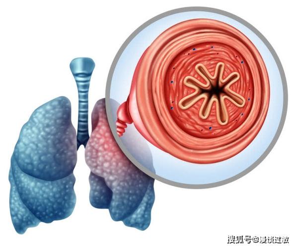 慢性阻塞性肺病会导致呼吸困难.