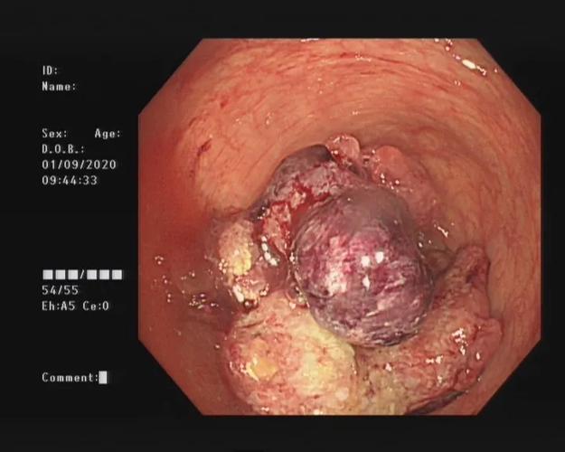 肠癌信号提示了她5年抵触肠镜心存侥幸如今被确诊
