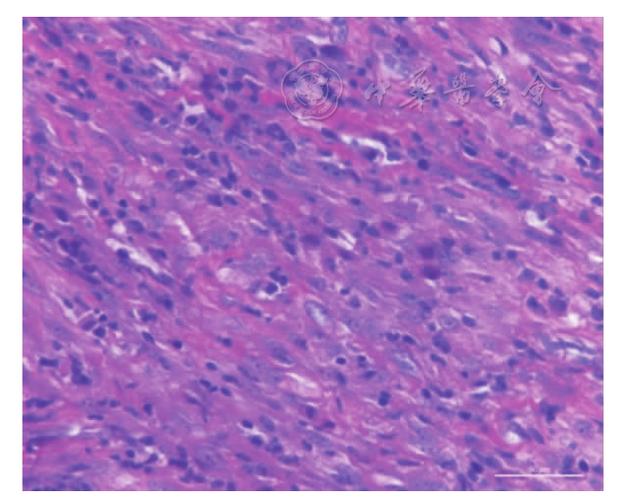 心脏原发炎性肌纤维母细胞瘤1例