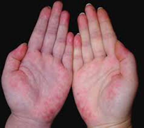 糖尿病的胼胝图片