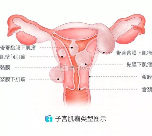 子宫容易长肌瘤的女人,都有这1个共性!发现异常别大意