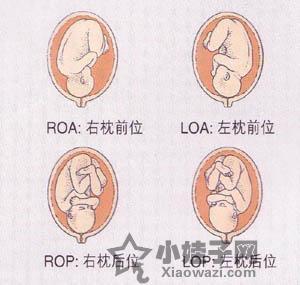 胎位loa是什么意思