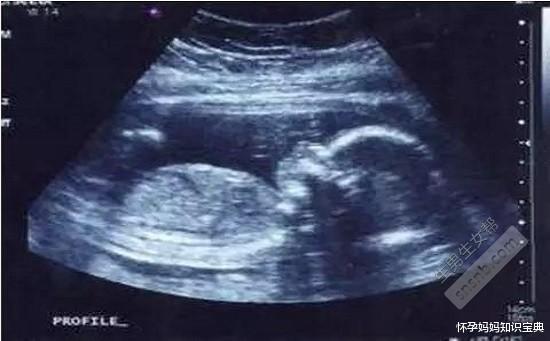 彩超单看胎儿性别,您学会了吗?|女宝宝|孕囊_网易订阅