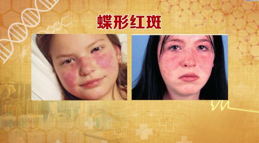 78蝶形红斑:鼻子的两侧出现蝴蝶一样的红斑.