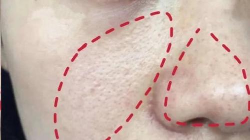 关于面部脂溢性皮炎的分享