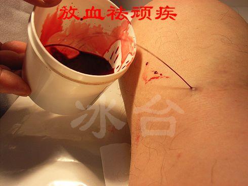 在昆明学习中医康复理疗要多少钱