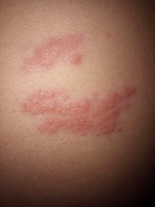 开始有点痒,挠了之后就这样了,看起来又像皮癣又像湿疹,也不知道到底