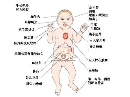 【如何预防小儿唐氏综合症】怎样预防唐氏宝宝_(2)