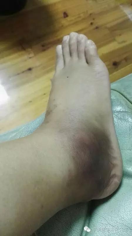 脚崴伤脚崴伤护理第三次淤血消失正常走路