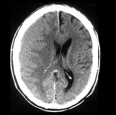 病例2 一位近期外伤患者的头部ct,主要异常表现是什么,什么继发