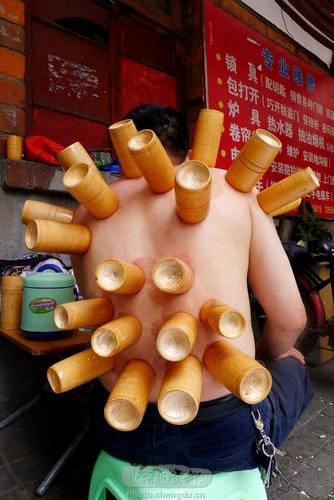 拔火罐新法浅散法