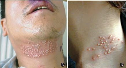 单纯疱疹病毒临床表现与治疗