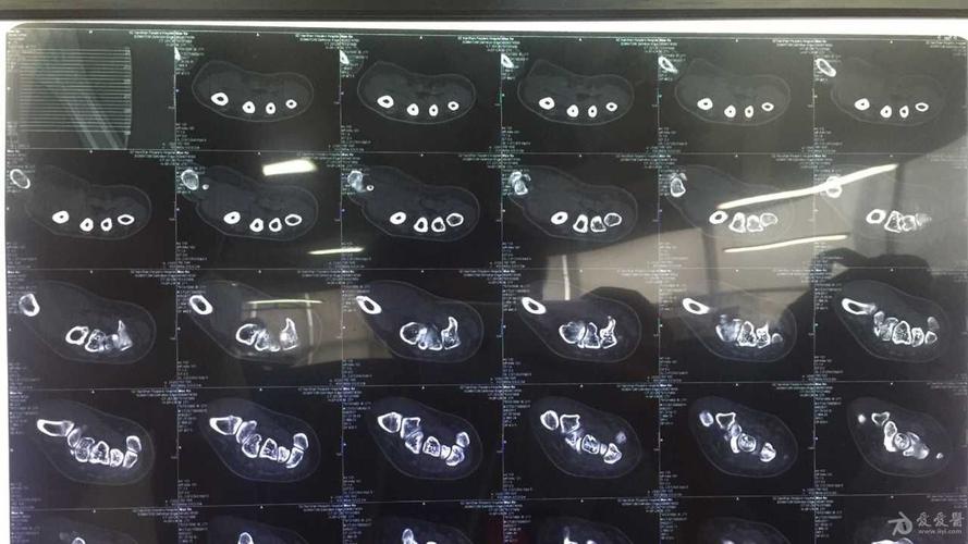 请帮忙看下左腕舟骨骨折谢谢