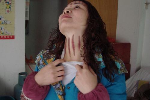 扭痧视频 让你更直观的了解扭痧