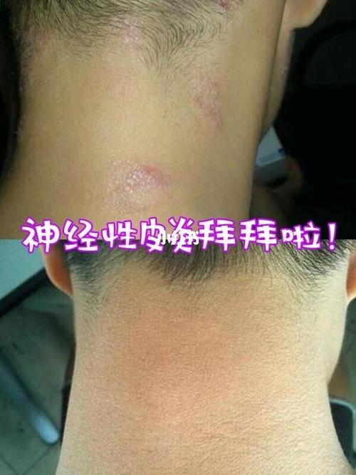 神经性皮炎拜拜啦!_皮炎_红疹_药膏_止痒_医疗健康