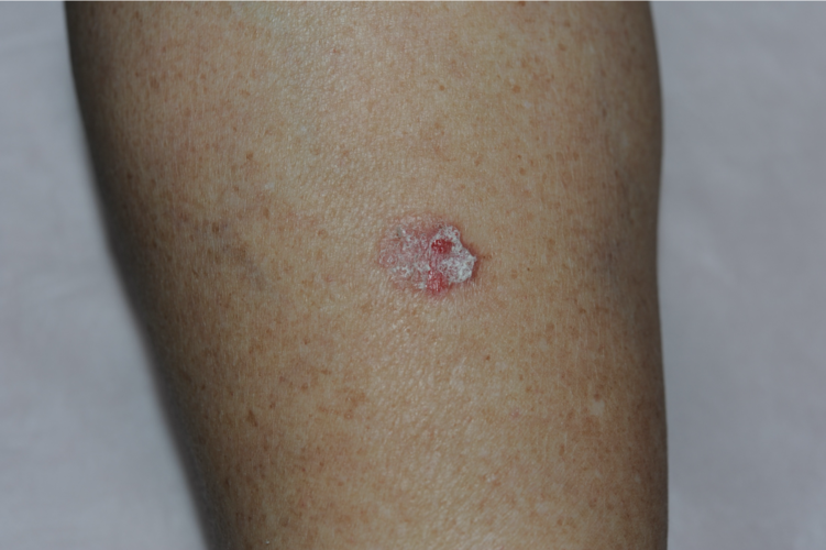 鳞状细胞癌早期会表现为皮肤上,尤其是日光暴露部位的红斑,斑块,表面