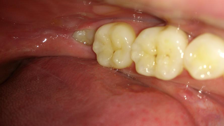 这个是智齿么?要不要拔掉呢