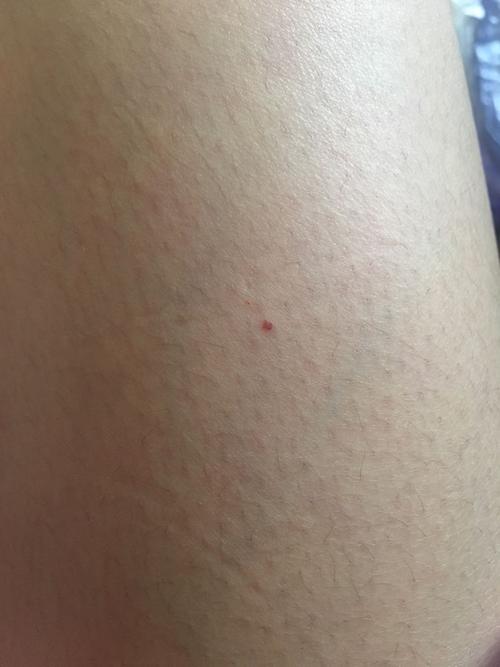 身上起了很多这种小红点,不痛不痒,好几年了最近又长了几个,请问这是