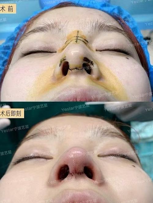 手术方案是:耳软骨鼻尖成形术 假体隆鼻 大翼软骨外侧角塑形 鼻翼