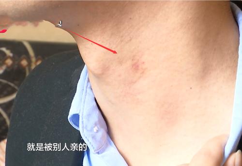贵阳:质疑脖子有草莓印,男子医院检查证清白,希望女友