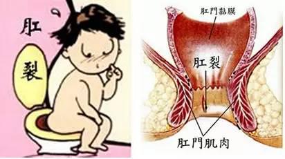 以排便时肛门周期性疼痛,厕纸染血或鲜血附于粪便表面,恶性循环的