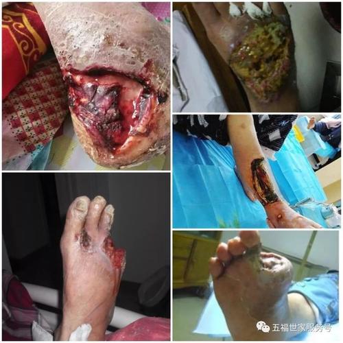 如何不做糖人,远离糖尿病并发症呢?