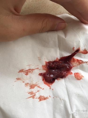 我想问一下这个是流出孕囊还是胚胎?是不是