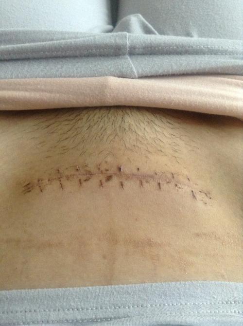 刨腹产第十一天的疤痕,正在使用疤痕敌 舒痕胶