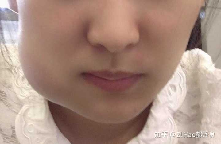 为什么医生不让我一次性把智齿都拔了?