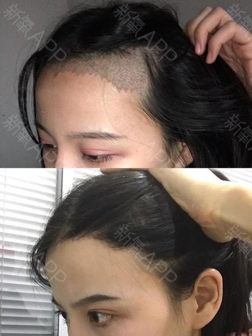 前面种植区的头发已经长到鼻子了,我发现种植的发际线跟天生的发际线