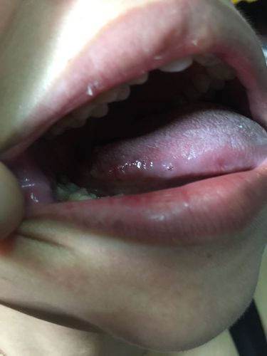 舌根长红色水泡